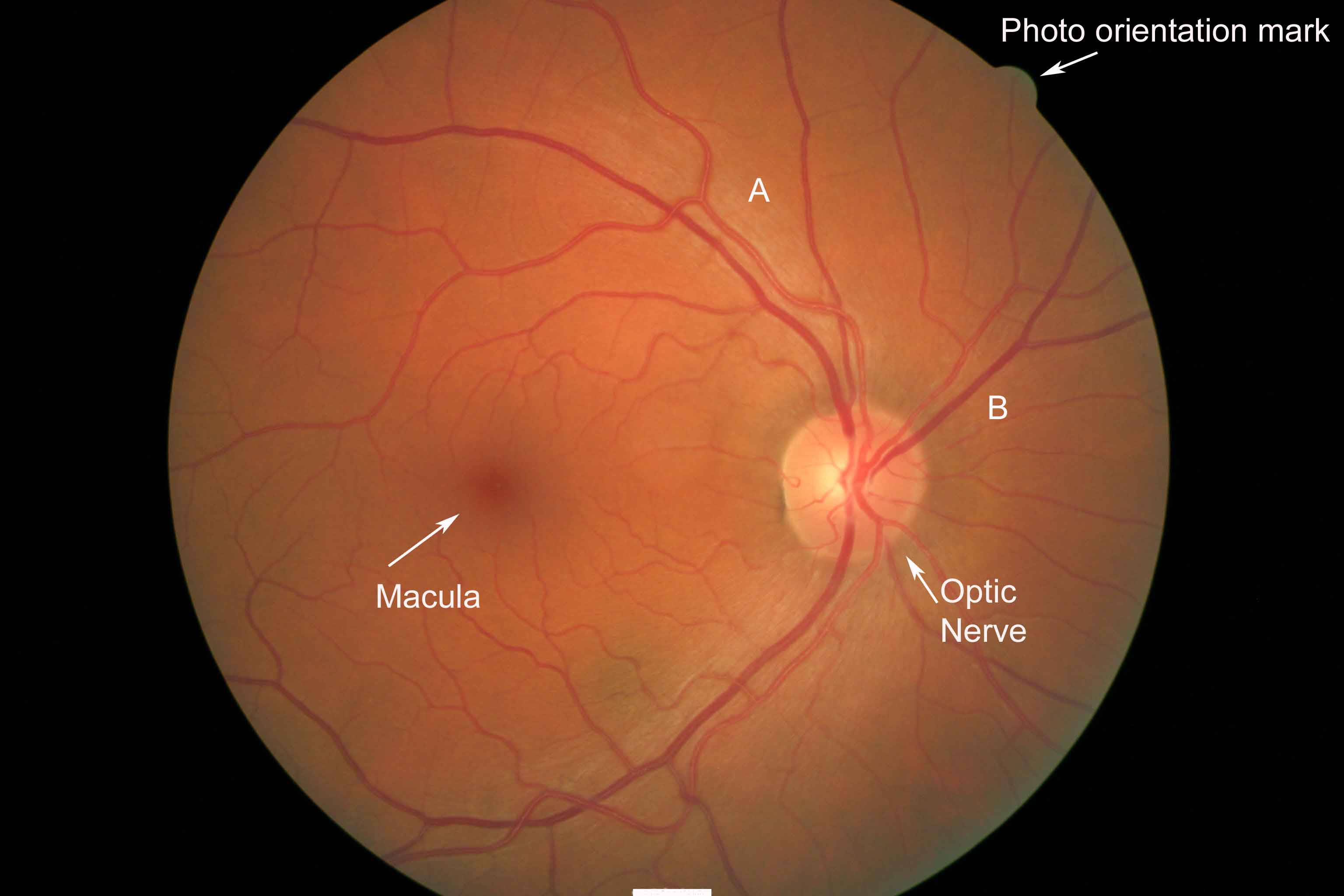 retinal photo